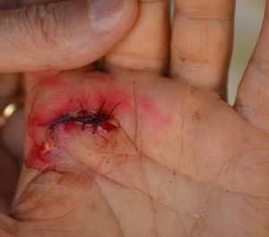 MukerjiLaw CHILD INJURY LEARN HOW TO TAKE QUALITY PICTURES FOR YOUR CASE 300x264