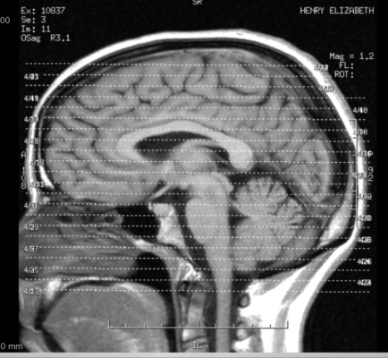 MukerjiLaw HEAD INJURIES WHAT ACTUALLY HAPPENS TO YOUR BRAIN 434x400
